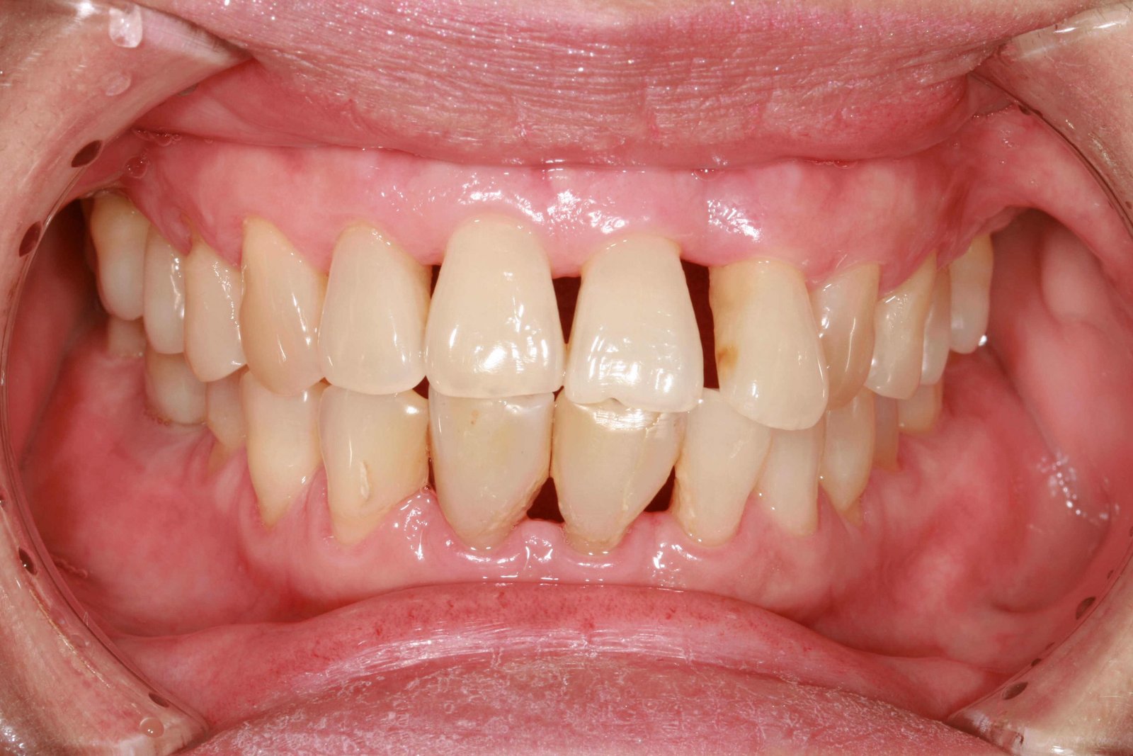 How to Tell If Gums Are Receding. https://howtokings.com/