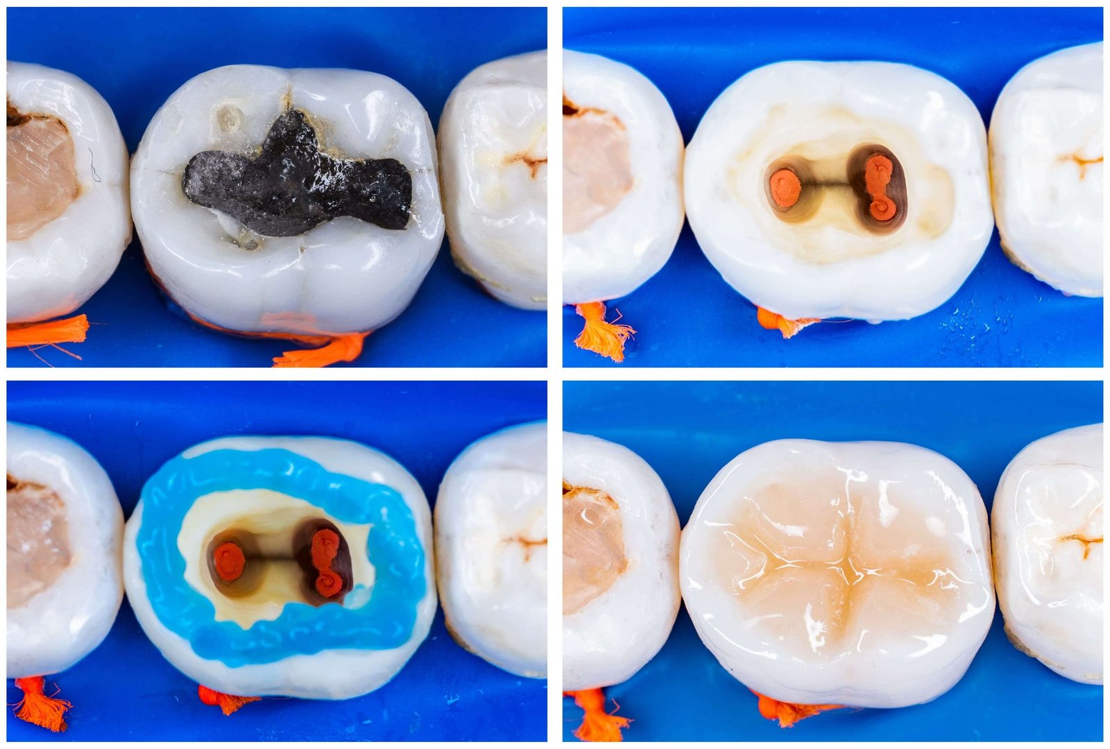 how long does a root canal last. https://howtokings.com/