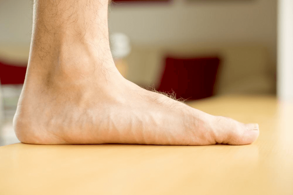 One image of a flat left foot - what are flat feet. https://howtokings.com/